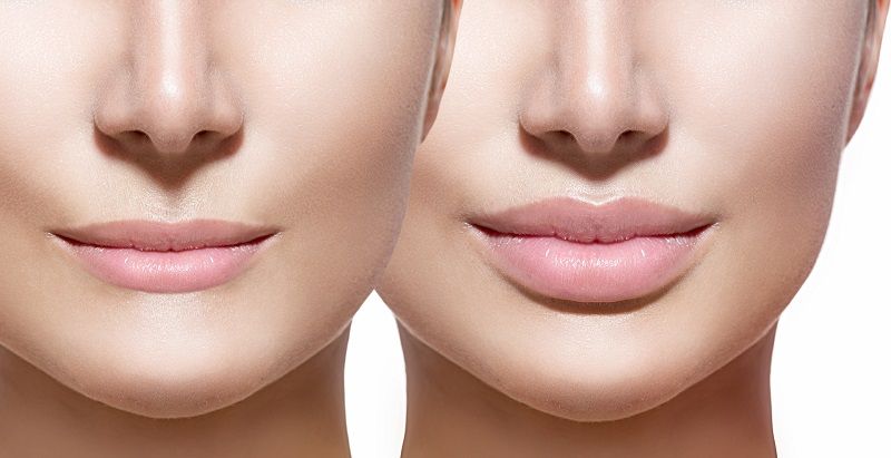 relleno-de-labios-FB