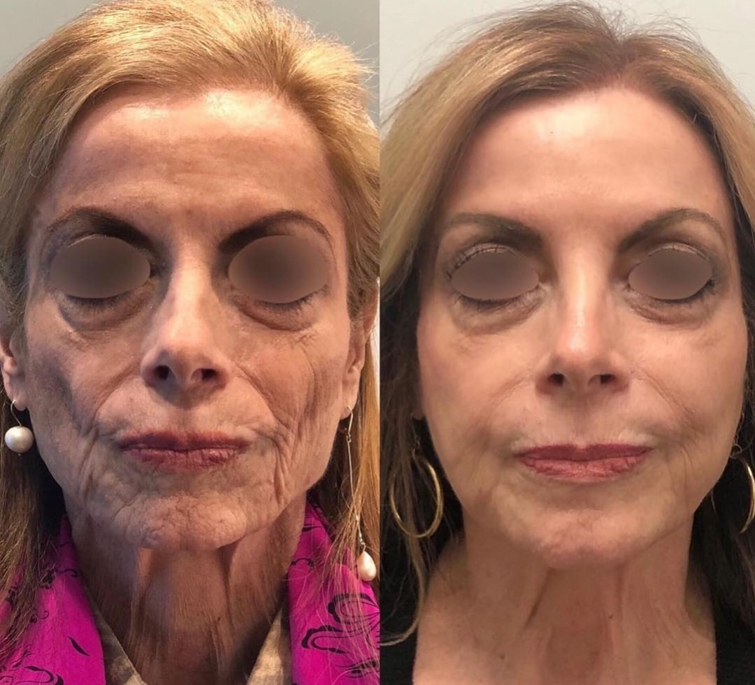 armonización facial