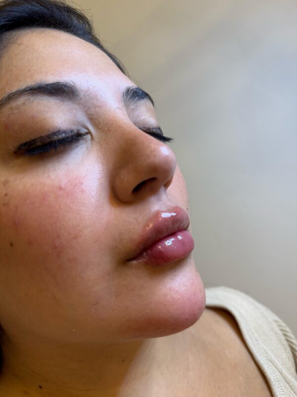Labios con Ácido Hialurónico - Imagen 2