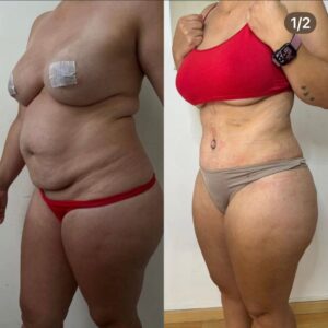 Abdominoplastia