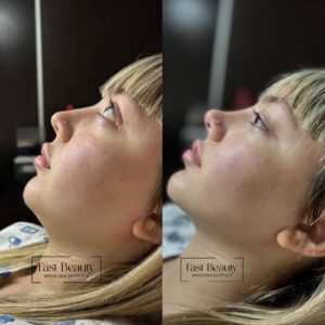 Contorno mandibular con Ácido Hialurónico