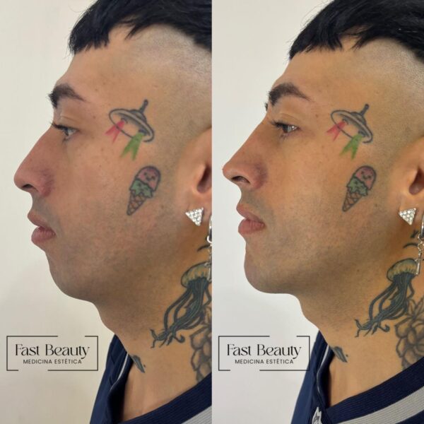 Contorno mandibular con Ácido Hialurónico - Imagen 2
