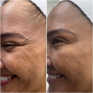 Botox tercio superior