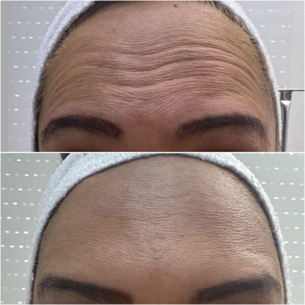 Botox tercio superior - Imagen 3
