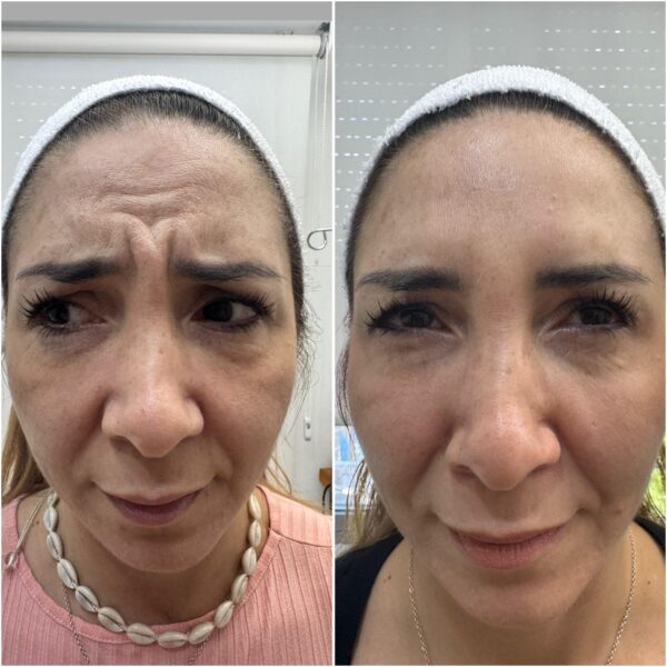 Botox tercio superior - Imagen 2