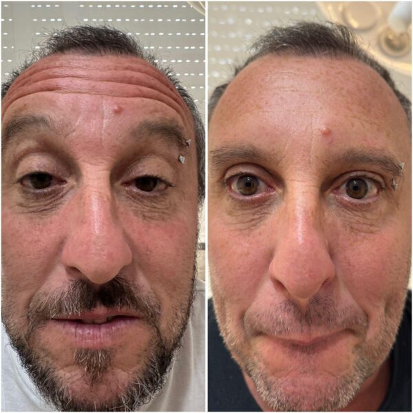 Botox Full Face - Imagen 2