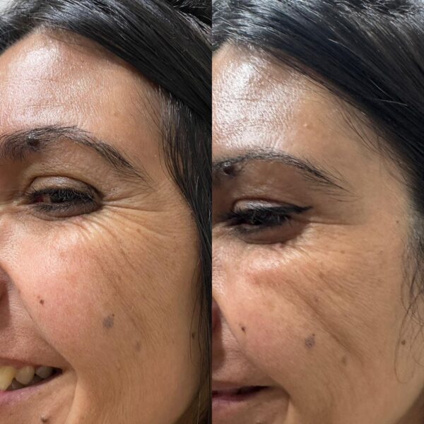 Botox Full Face - Imagen 3