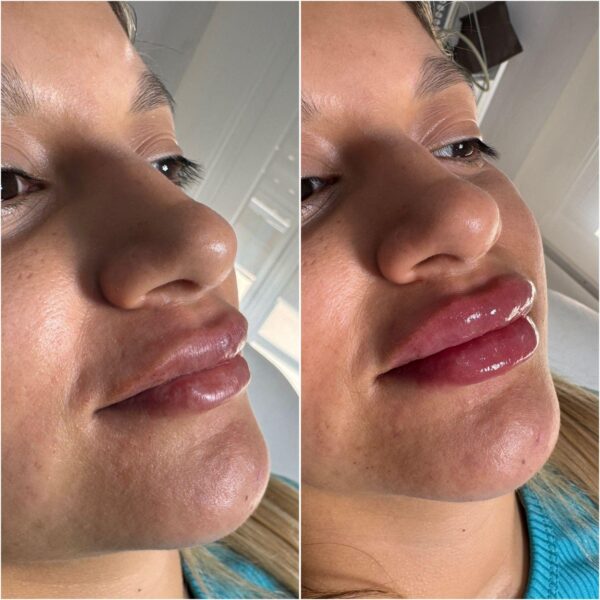 Labios con Ácido Hialurónico