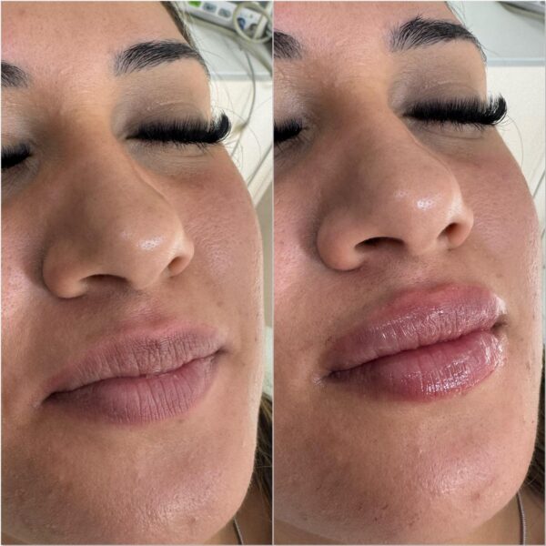 Labios con Ácido Hialurónico - Imagen 3