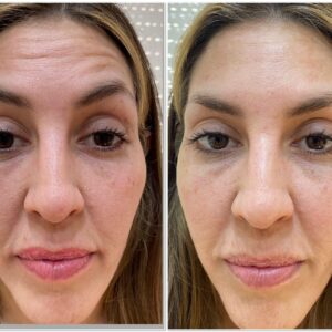 Botox Full Face