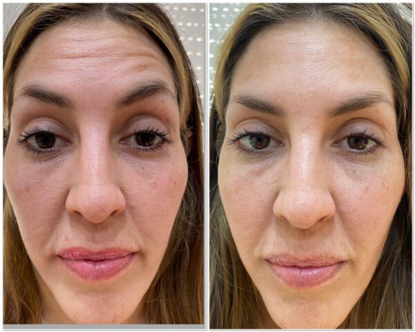 Botox Full Face