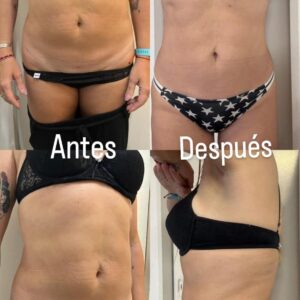 Mela abdomen y flancos