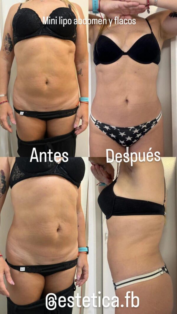 Mela abdomen y flancos