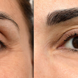 Blefaroplastia superior ambulatoria