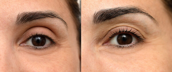 Blefaroplastia superior ambulatoria