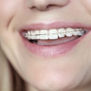 Brackets de porcelana ambos maxilares