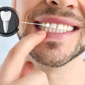 Implante dental acrílico