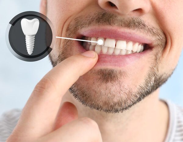 Implante dental acrílico