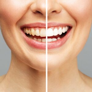 Blanqueamiento dental UV