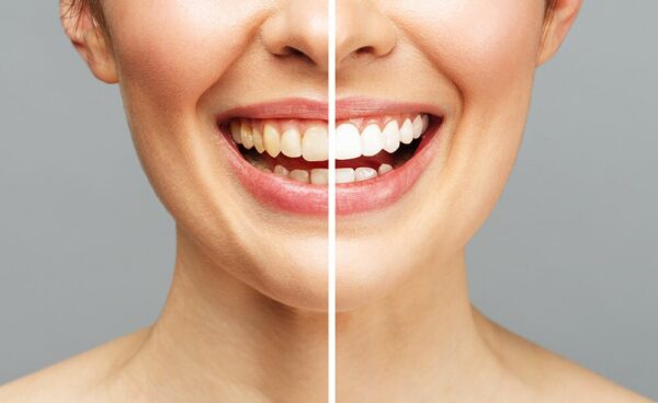 Blanqueamiento dental UV